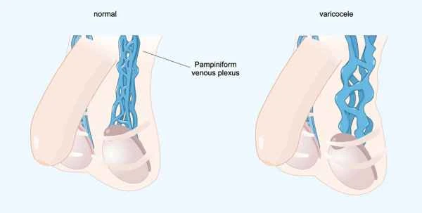 Can a blocked vas deferens cause ejaculation?
