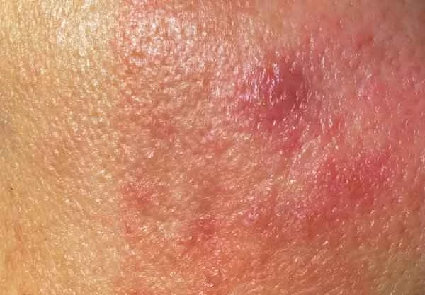 What causes itching in a young boy's scrotum?