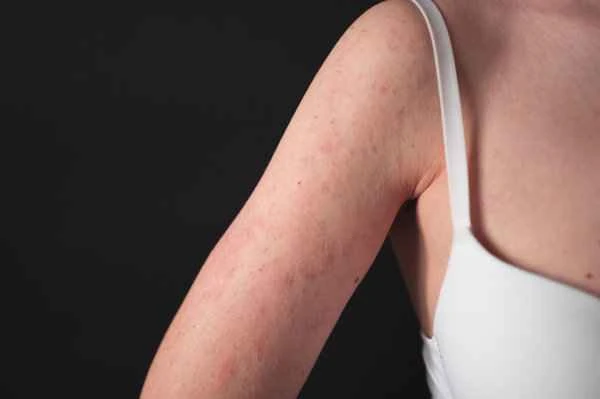 What ointment should I apply for scrotal inflammation?