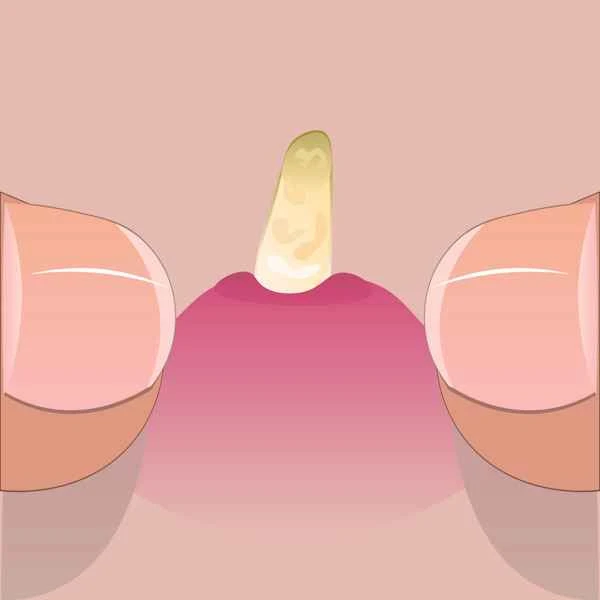 Does scrotal granuloma need to be removed?