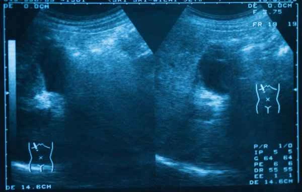 What surgery is needed if there are problems with scrotal ultrasound (CDFI)?
