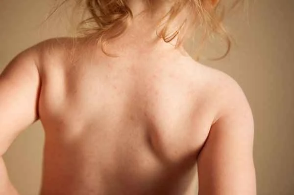 What causes penile and scrotal itching?