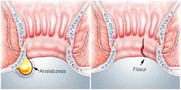 Chronic prostatitis with left scrotal pain