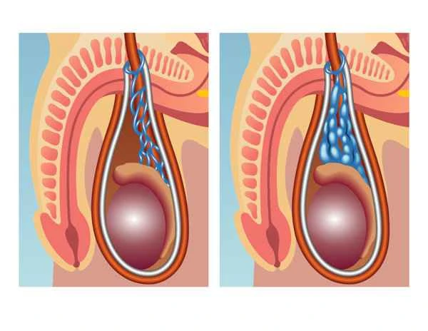 Prostate calcification and prostate massage