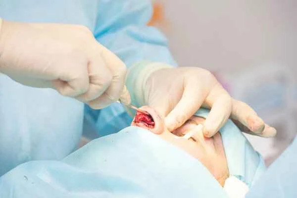 Does scrotal granuloma need to be removed?