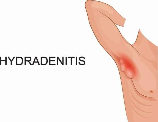 How to differentiate between scrotal dermatitis and scrotal cancer