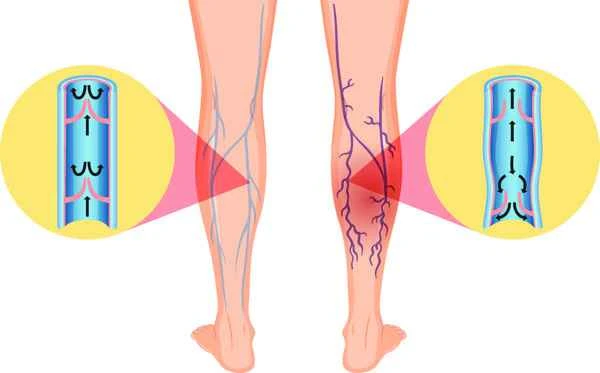What are the dangers of scrotal varicose veins?