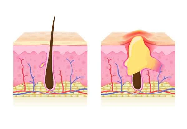What causes scrotal smegma?