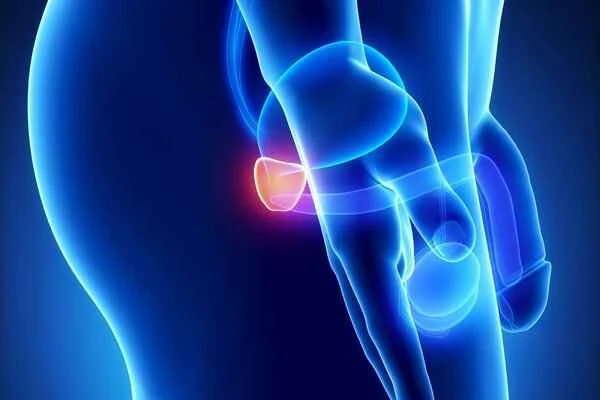 Where does prostate calcification typically occur?