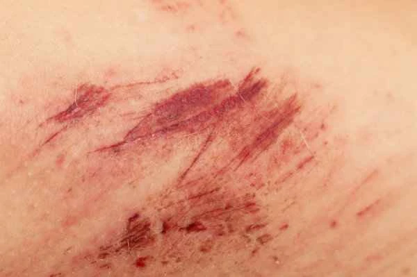 Is it normal to have blood streaks on the scrotum?