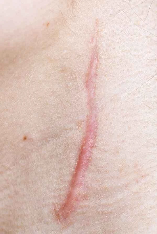 How to remove scars from foreskin?