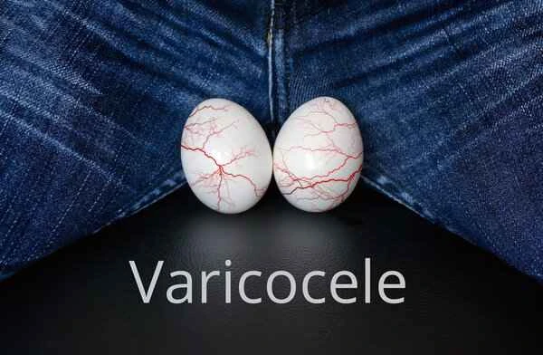 Symptoms of varicocele reflux