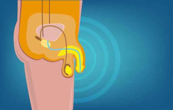 Does chronic aseptic prostatitis hurt?