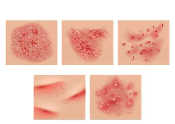 What to do about itching from balanitis?