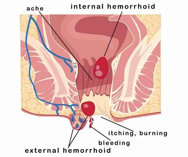 Scrotal inflammation causes redness and itching upon waking.