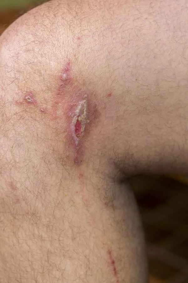 Intermittent itching of the glans penis