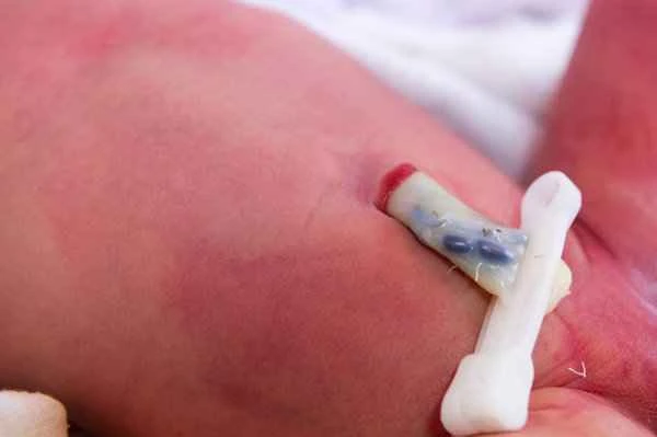 What to do about bilateral scrotal effusion?