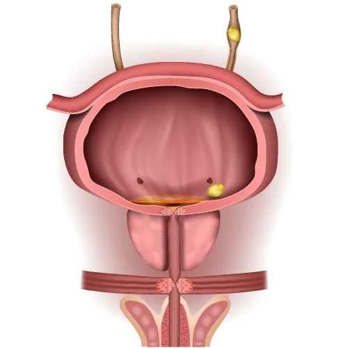 Can mild chronic prostatitis be cured in men?