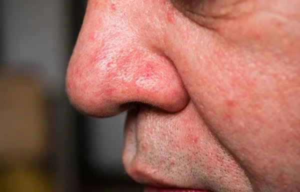 What causes pain on both sides of the scrotum?