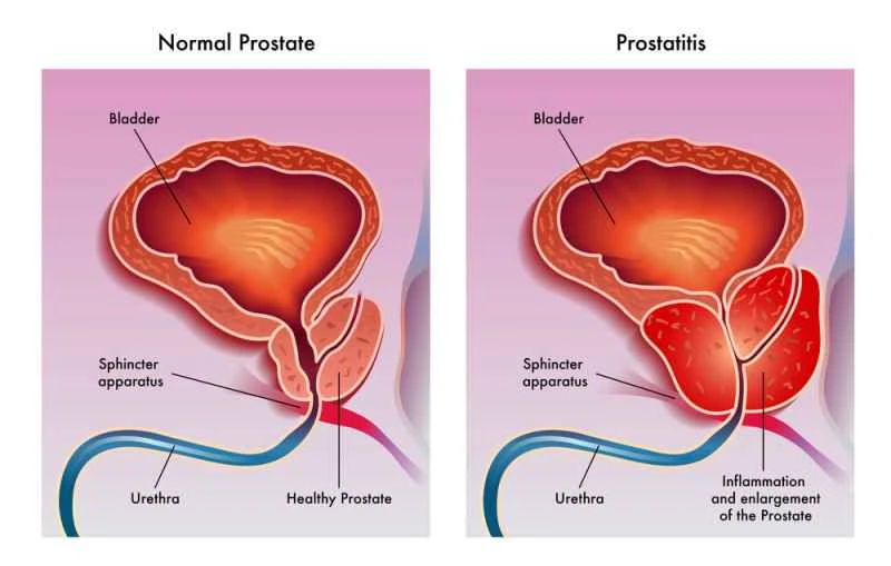 Can prostatitis be cured at age 14?