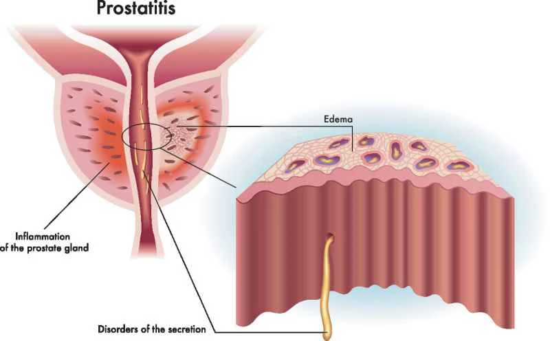 Can prostatitis at age 14 be cured?
