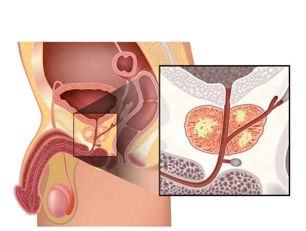 What causes pain around the scrotum?
