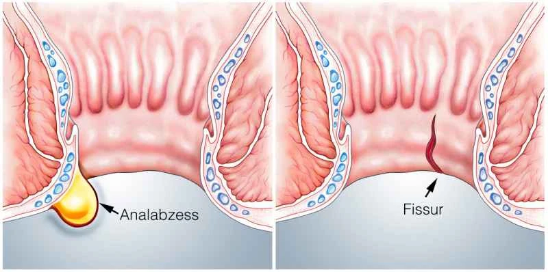 Can chronic prostatitis be transmitted to a woman?