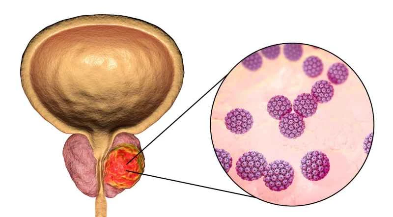 What bacteria cause bacterial prostatitis?